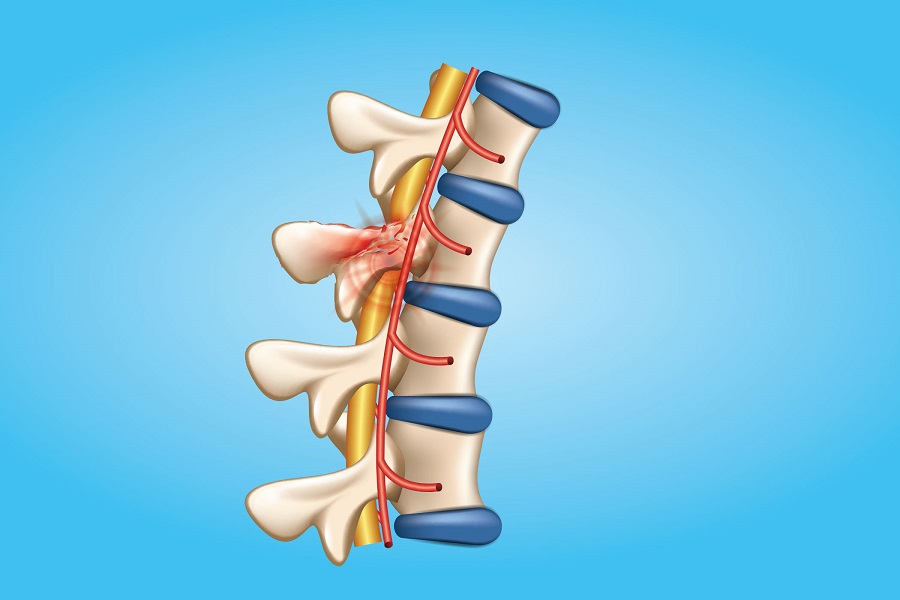 Các chấn thương ở cột sống có thể mang đến cảm giác đau nhức khó chịu cho vùng lưng