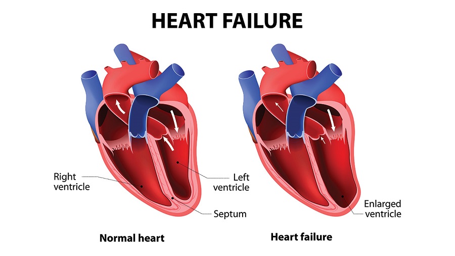 Suy tim khiến phổi bị ứ huyết do quá trình hút máu từ phổi về bị cản trở, vì vậy phổi mất tính đàn hồi, không giãn được để thở bình thường