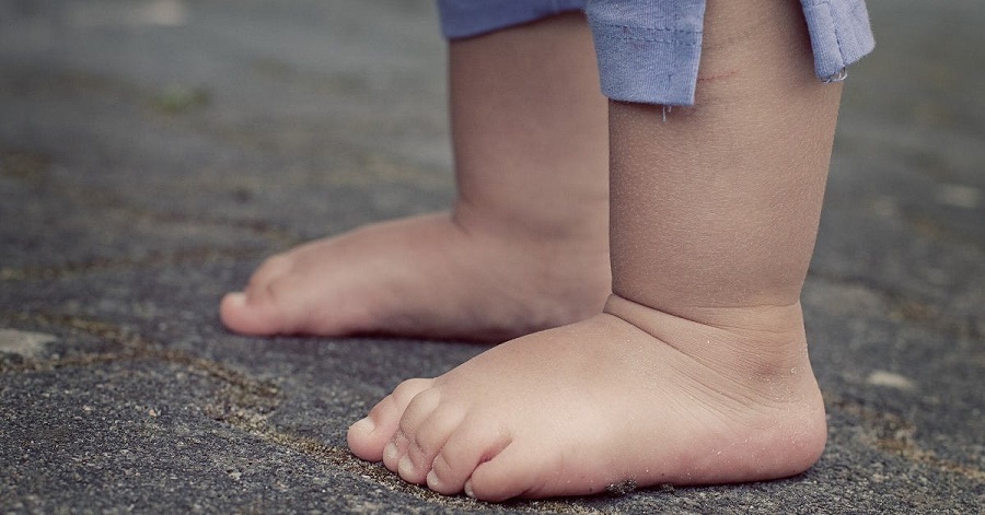 Dị tật bàn chân bẹt đôi khi có thể gây cảm giác đau ở lòng bàn chân