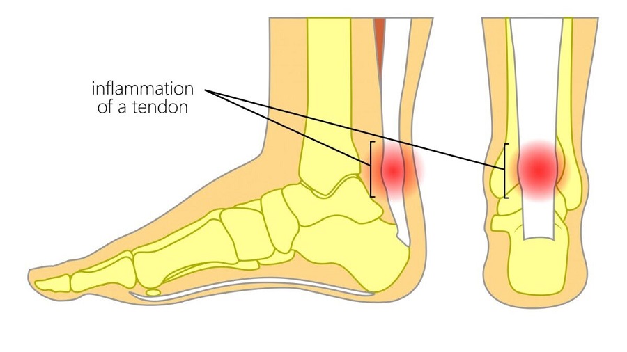 Viêm gân Achilles thường mang đến cảm giác đau ở vị trí lòng bàn chân và gót chân