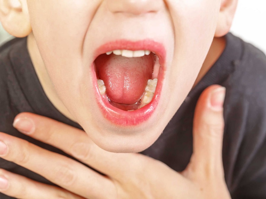 Nếu trẻ bị viêm amidan thì có thể được chỉ định cắt để ngăn chặn tình trạng thở qua miệng