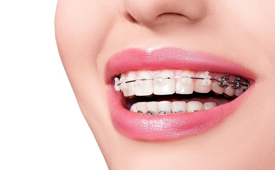 Chỉnh nha kéo răng, kéo hàm cũng là cách chữa bệnh thở bằng miệng hiệu quả